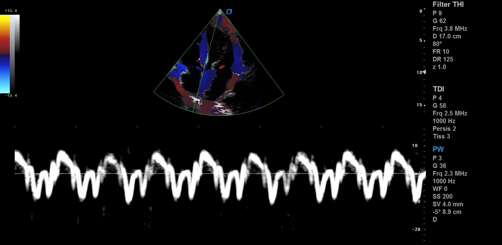 心臟彩超機(jī)和超聲心動(dòng)圖的區(qū)別？