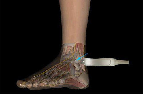 肌骨超聲：肌肉損傷超聲怎么看？